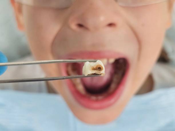 Best Emergency Tooth Extraction in Skyline, AL